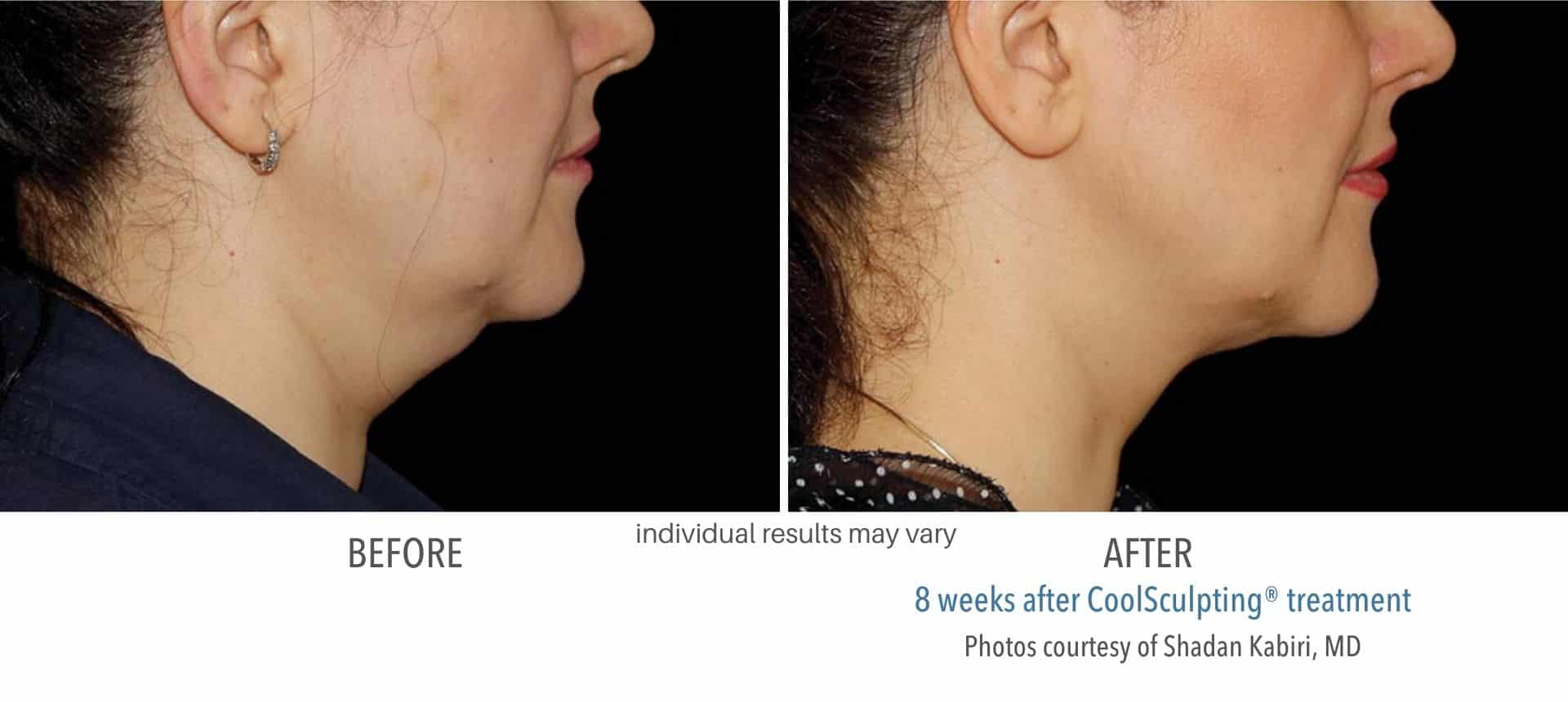 coolsculpting treatment double chin at Sculpt DTLA