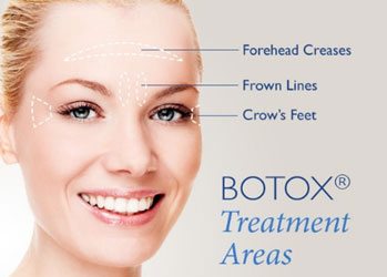 Facial injections treatment areas for Botox.