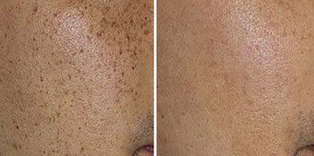 Laser treatment before and after at Sculpt DTLA in Los Angelas.