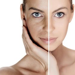 Laser skin rejuvenation before and after treatment available at Sculpt DTLA in Los Angelas.t