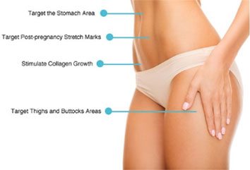 Stretch mark reduction areas of treatment at Sculpt DTLA in Los Angelas.