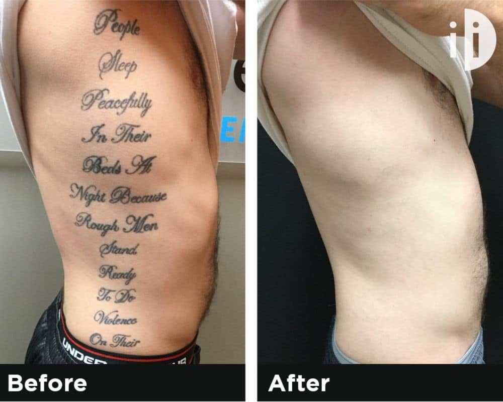 Laser Tattoo Removal Downtown LA | Befor & After Image 1