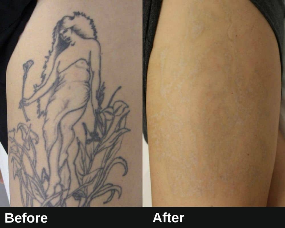 Laser Tattoo Removal Downtown LA | Befor & After Image 2