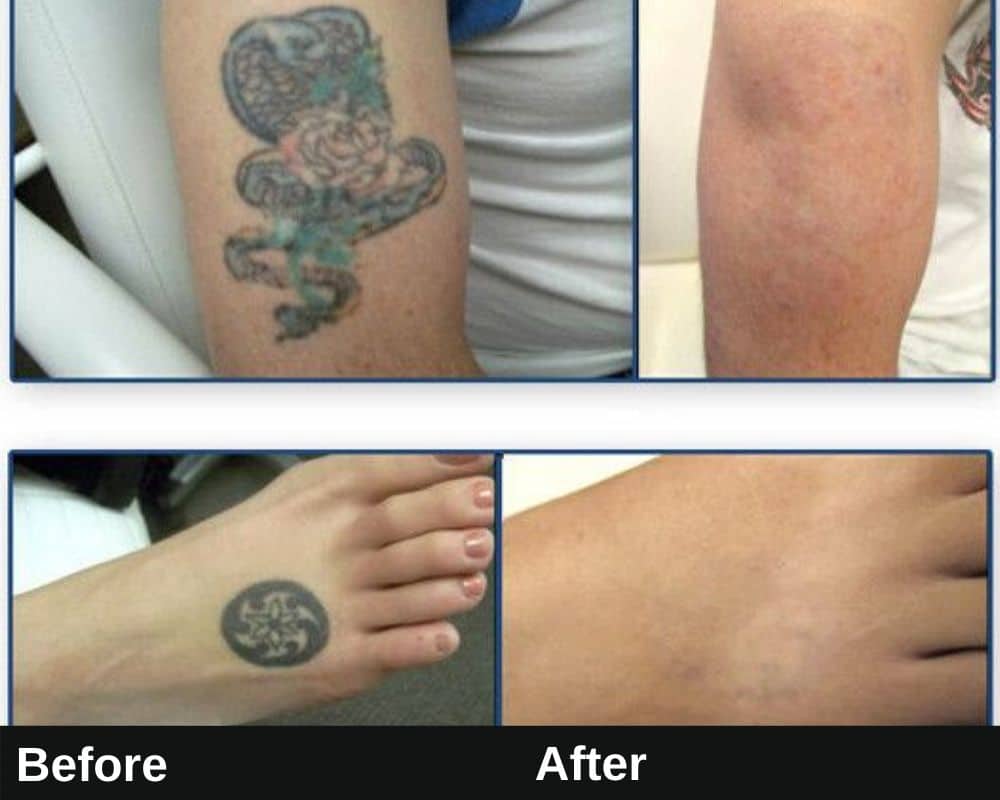 Laser Tattoo Removal Downtown LA | Befor & After Image 3