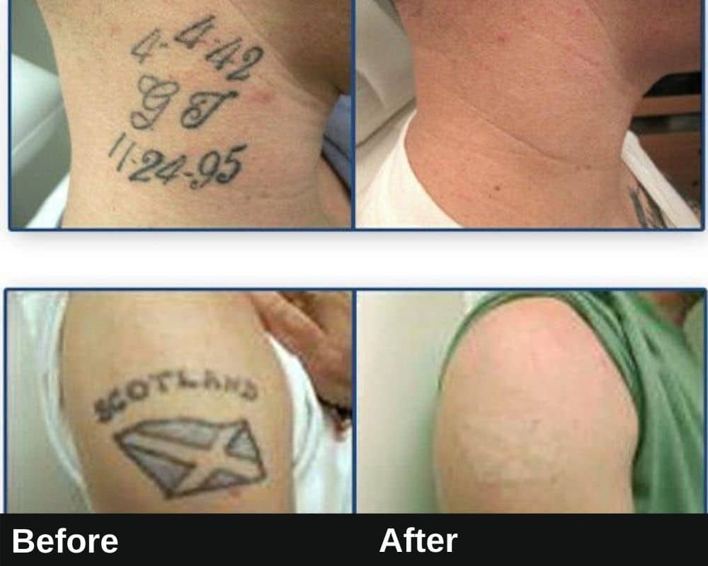 Laser Tattoo Removal Downtown LA | Befor & After Image 5