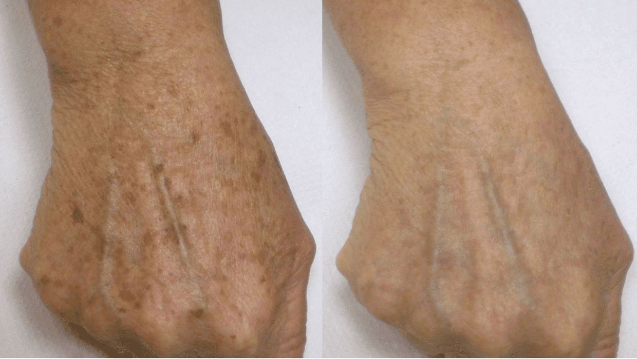 Laser Dark Spot Removal