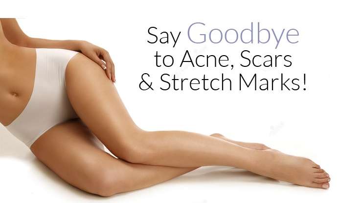 Understanding and Dealing With Stretch Marks
