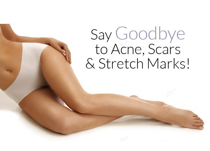 Understanding and Dealing With Stretch Marks