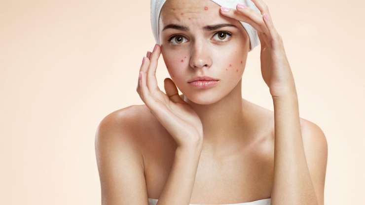 Essential Vitamins Necessary For Acne Treatment