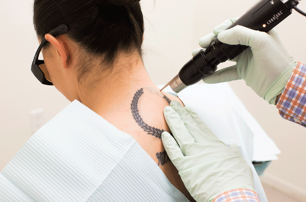 7 Frequently Asked Questions about Laser Tattoo Removal
