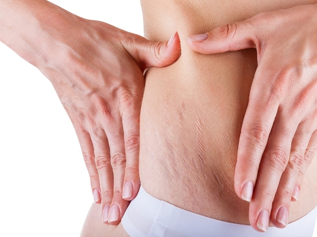 Causes, Risk Factors and Symptoms for Stretch Marks