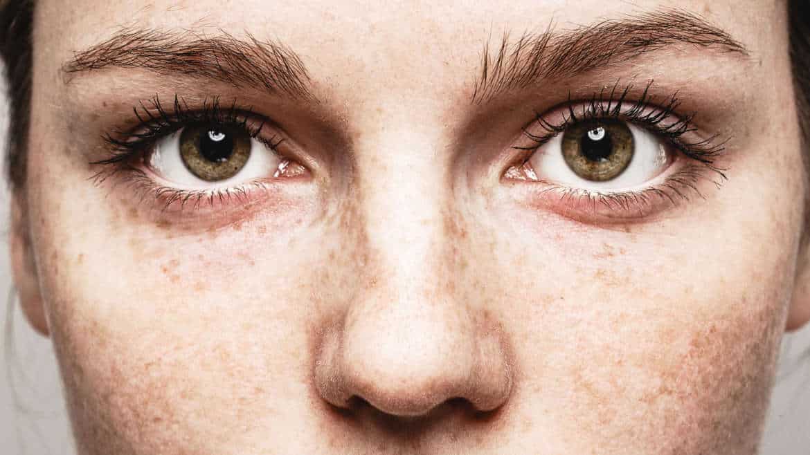 How To Identify And Treat Spots In The Skin