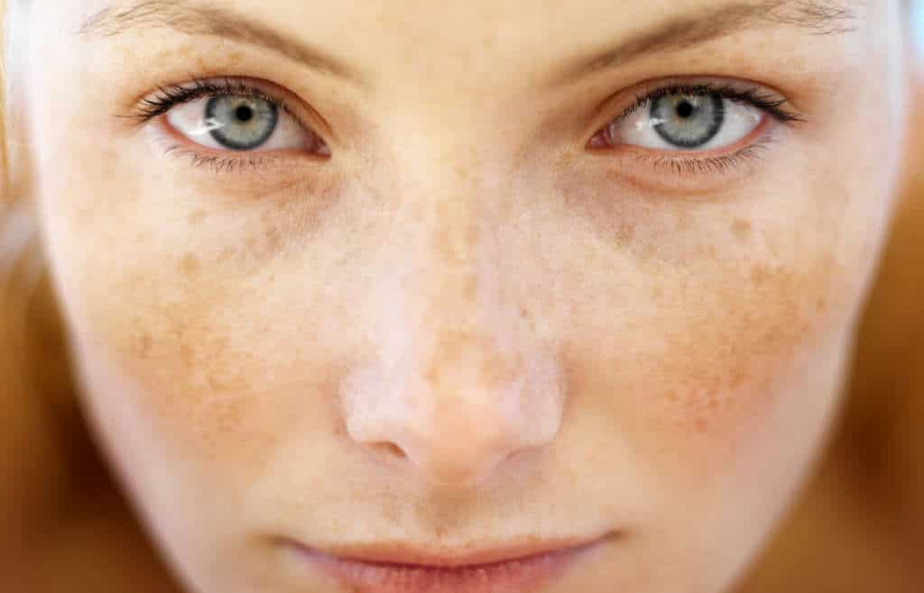 Sculpt Difference between Freckles & Sunspots