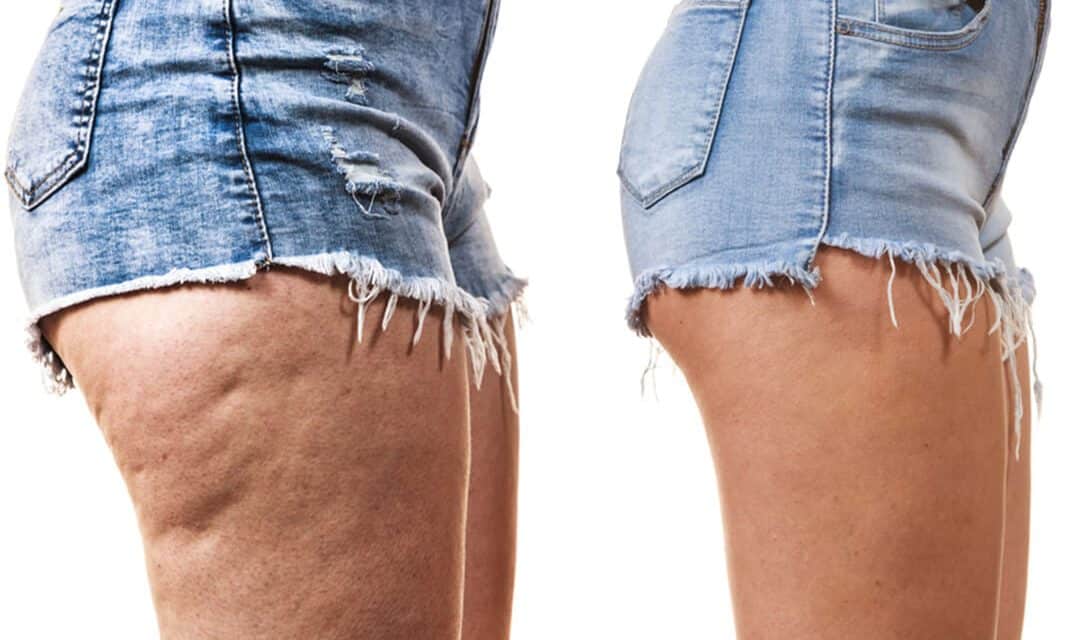 Symptoms And Causes Of Cellulite