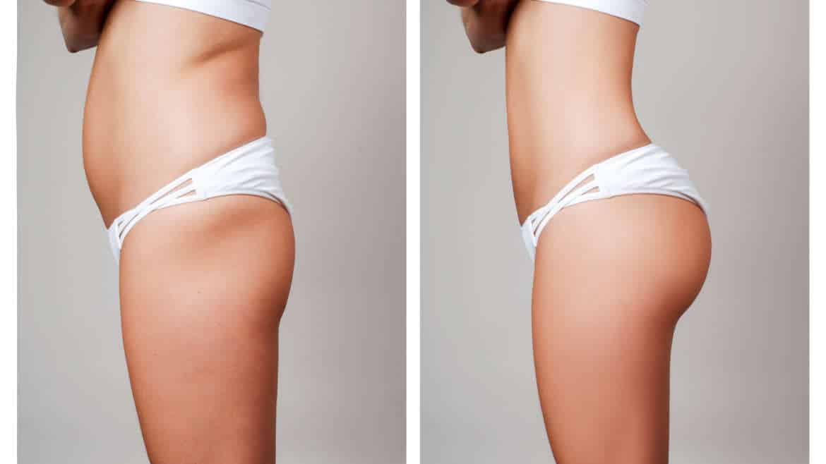 The Difference Between Sculptra Butt Lift and Brazilian Butt Lift