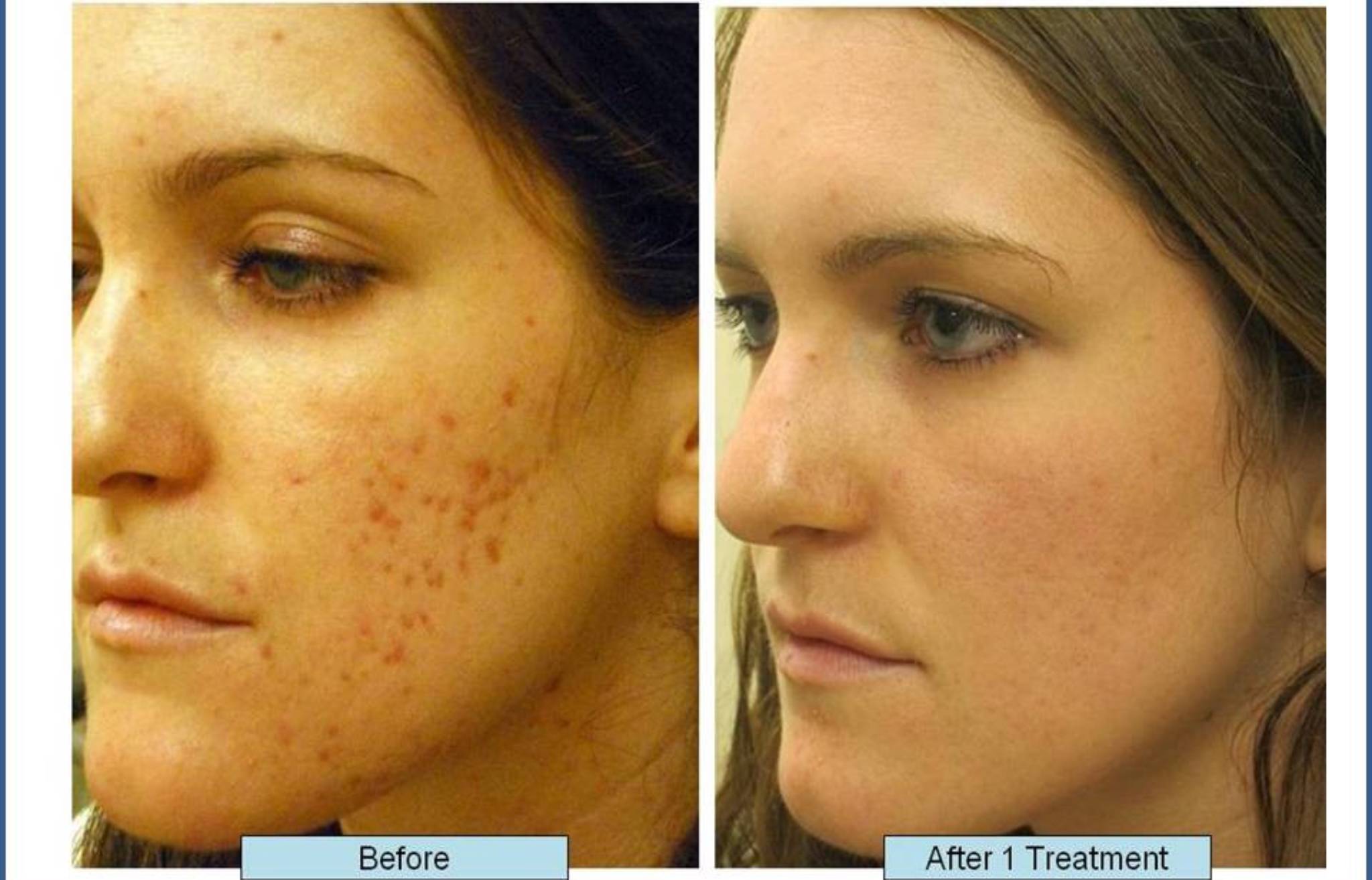 elegant-makeup-with-acne-scars-home-remedies-with-ask-the-acne-expert-when-should-a-new-acne-scar-be-treated (1)