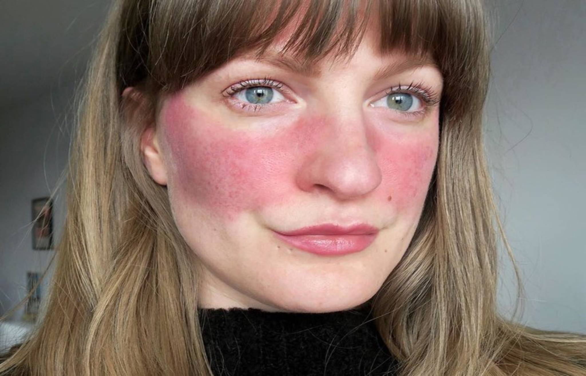 Rosacea Treatment Sculptdtlacom