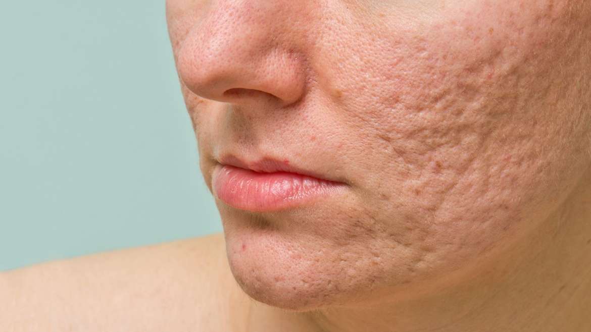 Causes and Preventative Tips for Acne Scarring