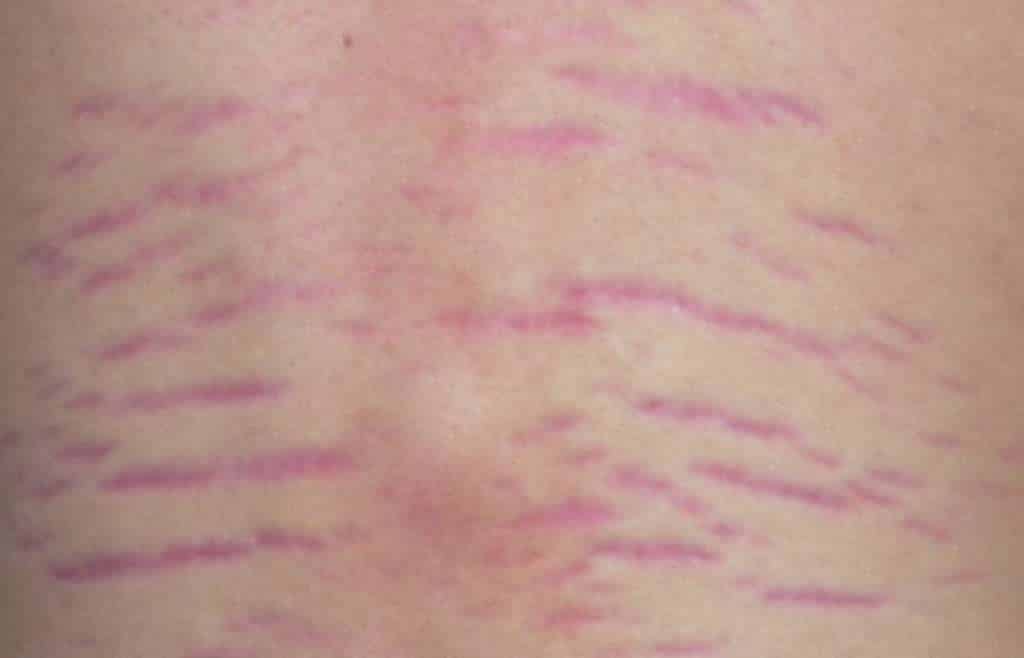 The Difference Between Red and White Stretch Mark