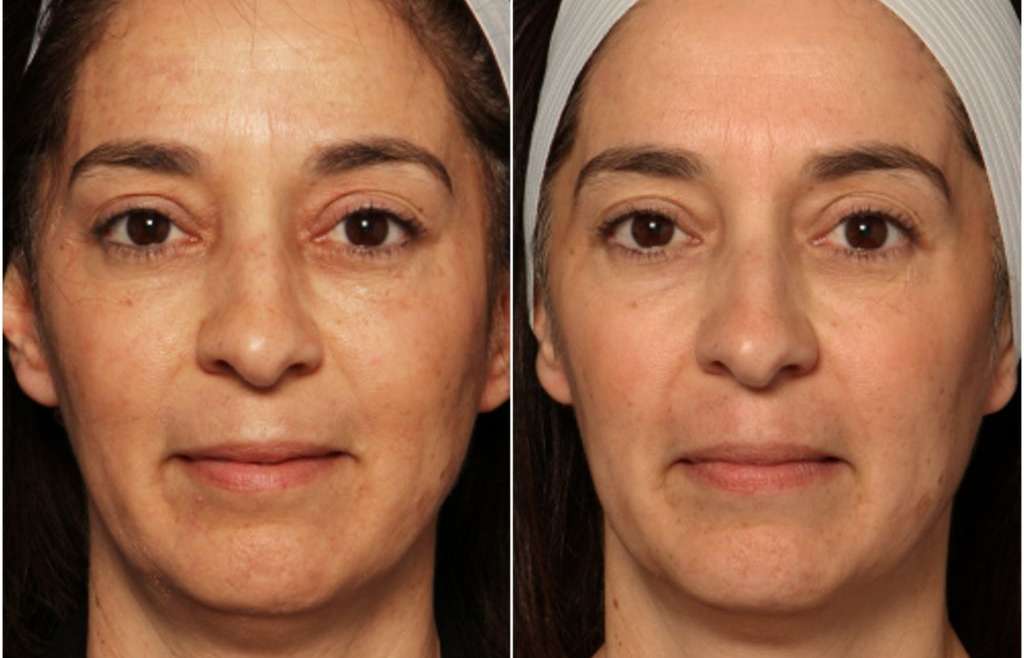 Things to Consider About Laser Skin Rejuvenation