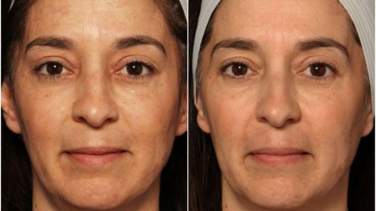 Things to Consider About Laser Skin Rejuvenation