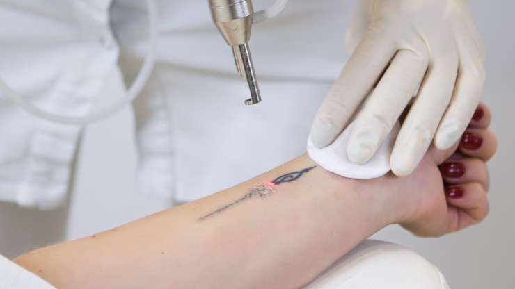 Preparing for Laser Tattoo Removal Treatment