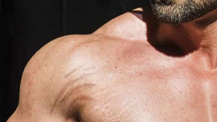 How to Avoid Stretch Marks from Weight Lifting