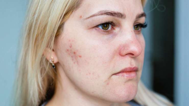 Laser Acne Treatment