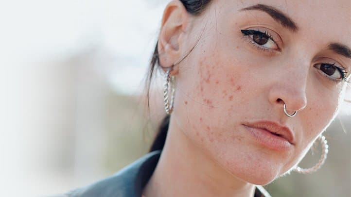 Is Acne Genetic?