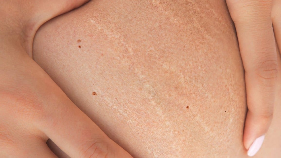 Are Stretch Marks Genetic?