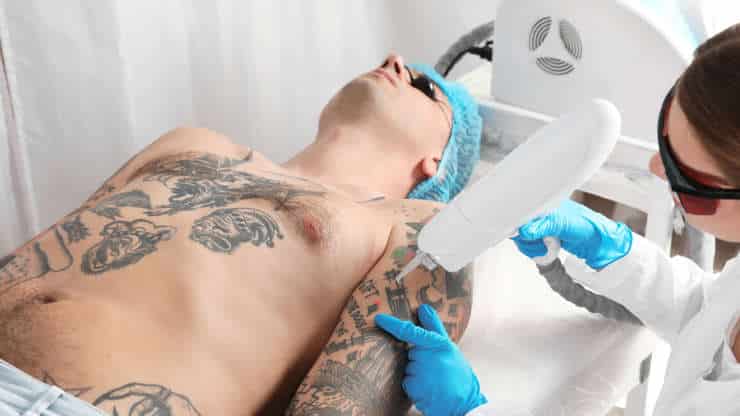Exercising Before and After Laser Tattoo Removal