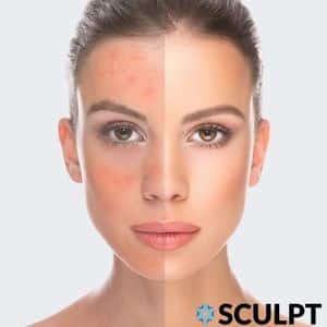 Acne Treatment Los Angeles