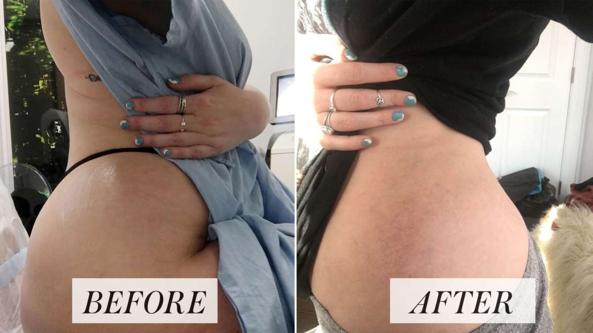 Can PRP + Microneedling Treat Stretch Marks?