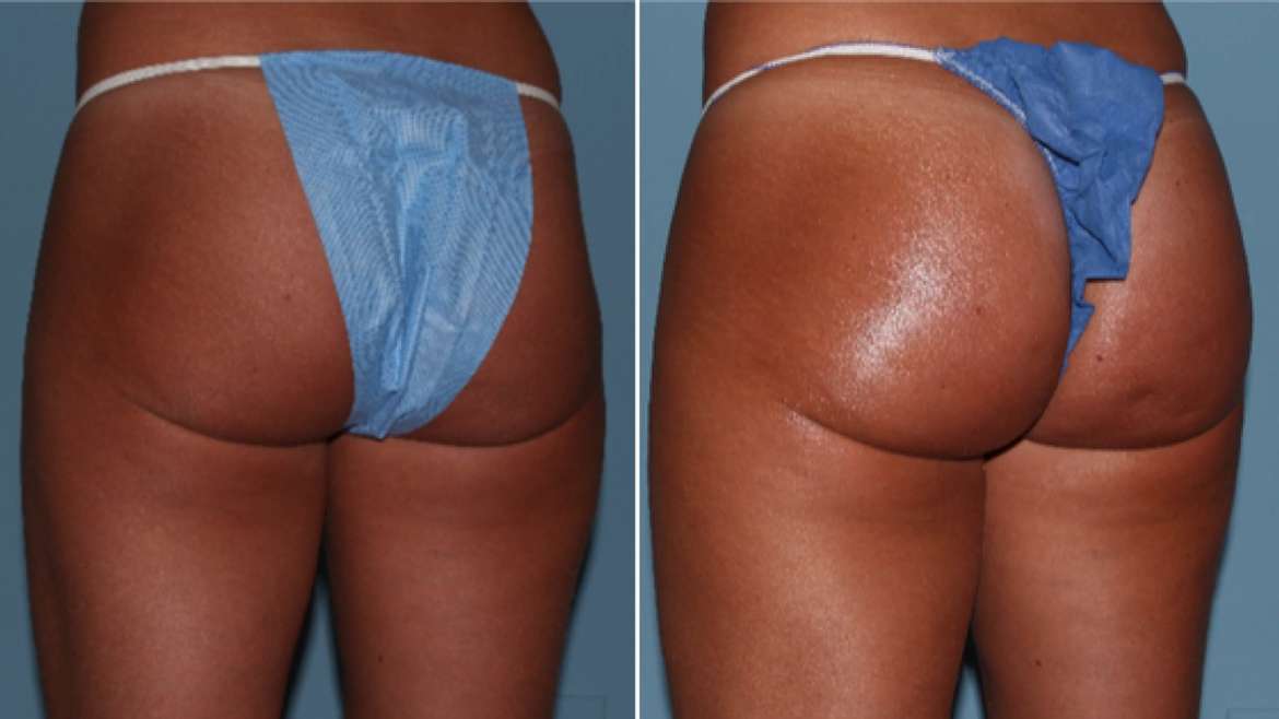 Can I Exercise After Sculptra Butt Lift?