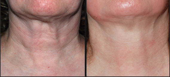 How Laser Skin Tightening Works