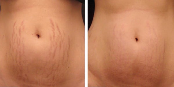 Ways to Get Rid of Stretch Marks