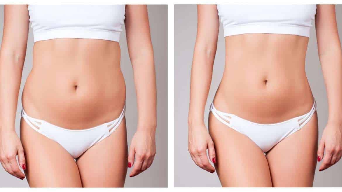 CoolSculpting Love Handles, Coolsculpting flanks before and after