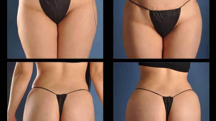 Rounder Hips With Sculptra
