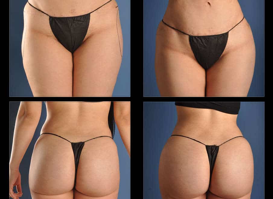 Rounder Hips With Sculptra
