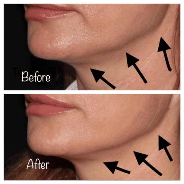 Can Botox Lift Jowls?