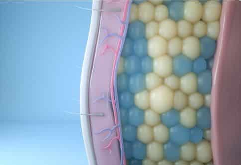 Fat cells during coolsculpting treatment.