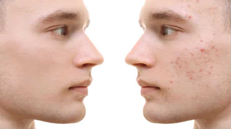 How to Treat Acne with Lasers and Light