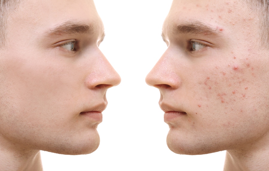 How to Treat Acne with Lasers and Light