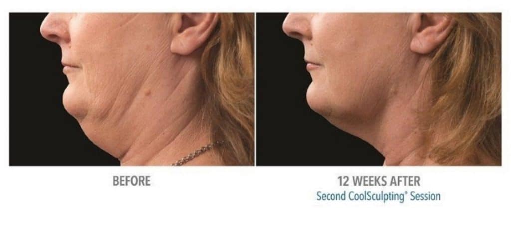 Womans chin before and after coolsculpting treatment at Sculpt DTLA in Los Angelas.