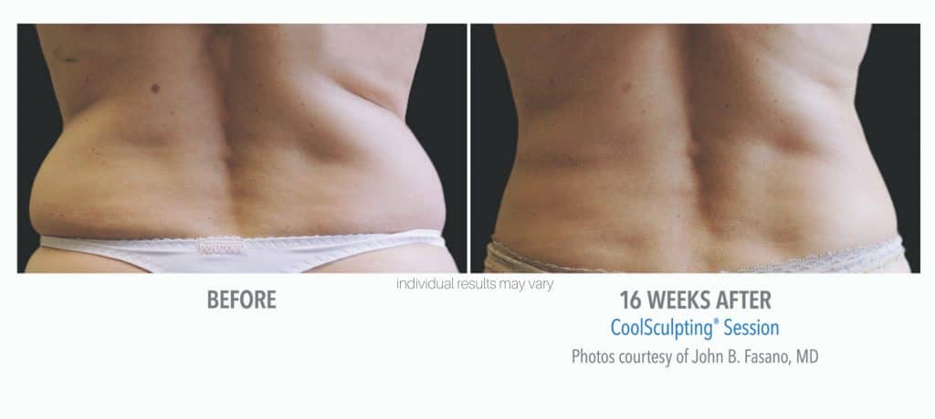 Womans back flanks before and after coolsculpting treatment at Sculpt DTLA in Los Angelas.