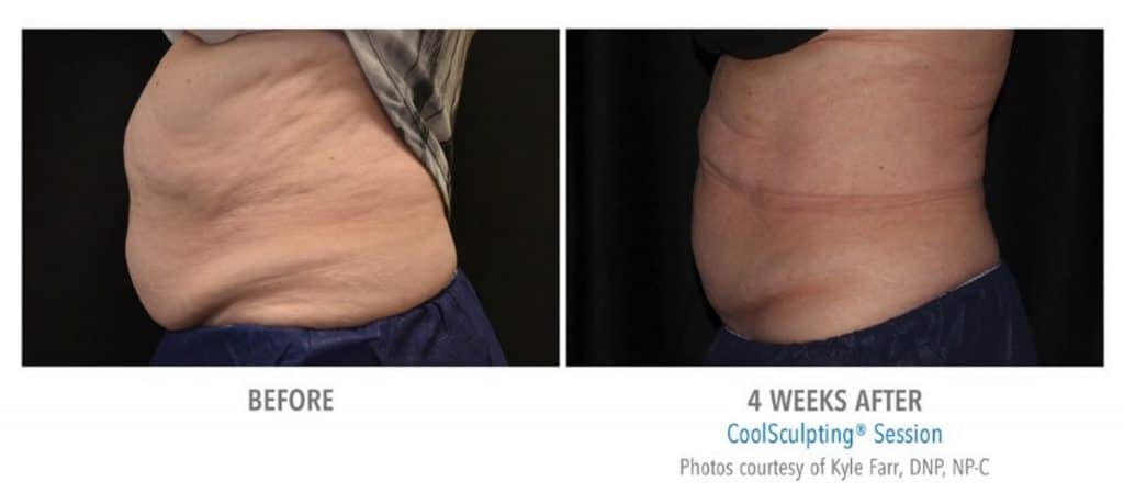 Abdomen before and after coolsculpting treatment at Sculpt DTLA in Los Angelas.