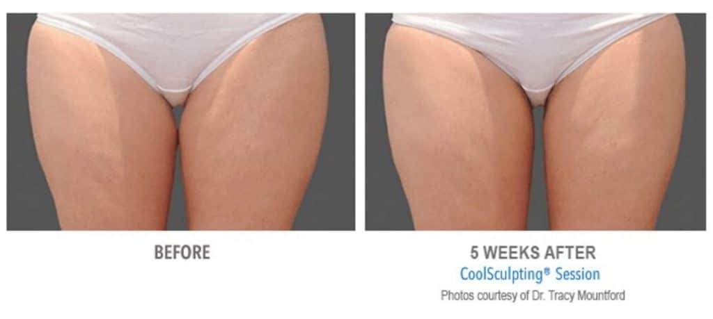 Womans thighs before and after coolsculpting treatment at Sculpt DTLA in Los Angelas.