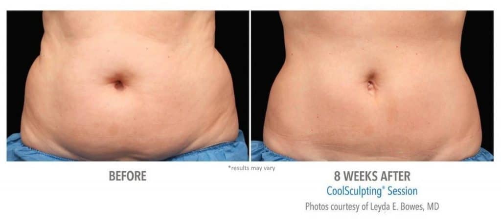 Womans abdomen before and after coolsculpting treatment at Sculpt DTLA in Los Angelas.