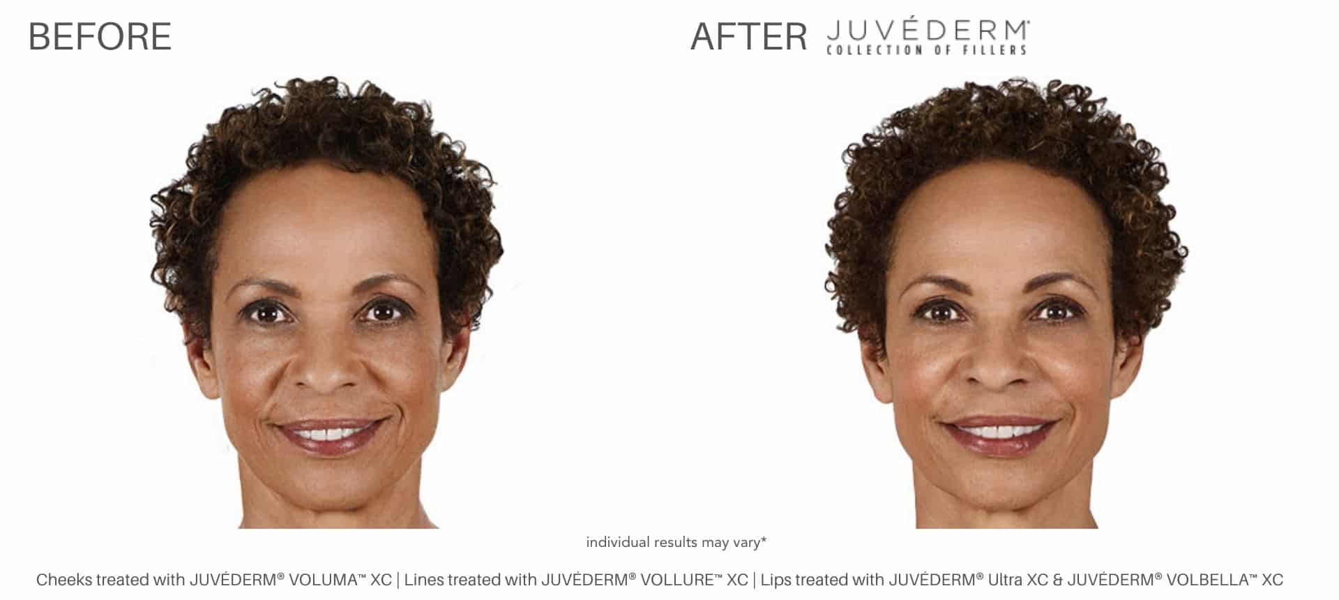 Juvéderm before and after results in Los Angeles, CA at Sculpt DTLA.