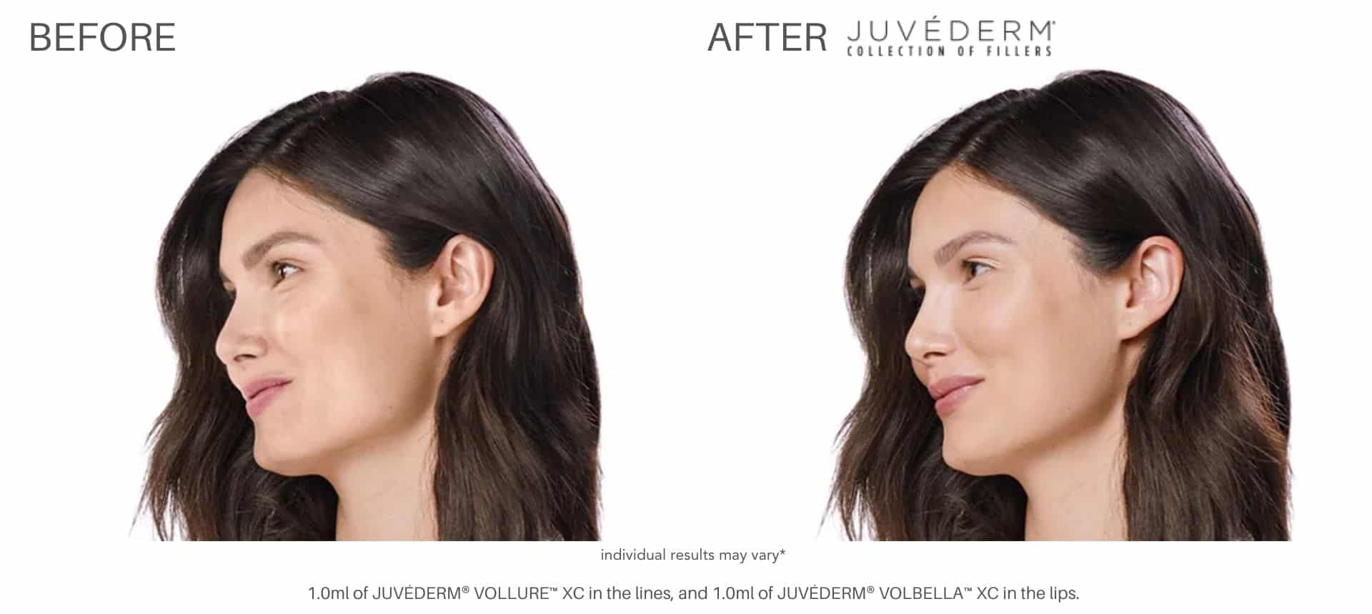 Juvéderm before and after results in Los Angeles, CA at Sculpt DTLA.